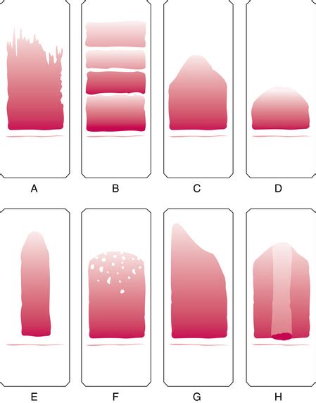 Introduction to peripheral blood smear examination | Oncohema Key