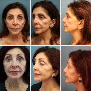 Botox For Neck Bands Before And After » Facial Injections: Info, Prices ...