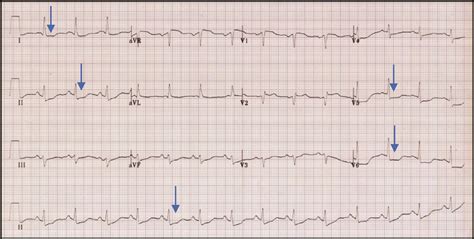 Nstemi Ecg - Posterior STEMI - Acilci.Net / Check spelling or type a new query.