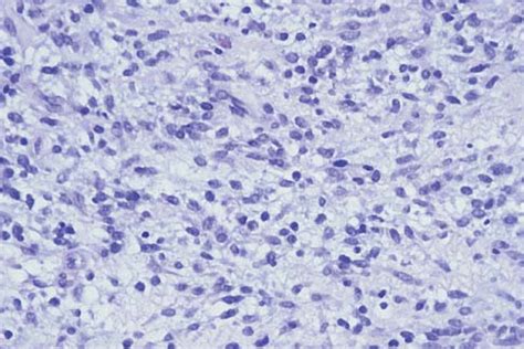 Soft Tissue Sarcoma - Pathology - Orthobullets