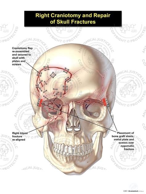 Right Craniotomy and Repair of Skull Fractures