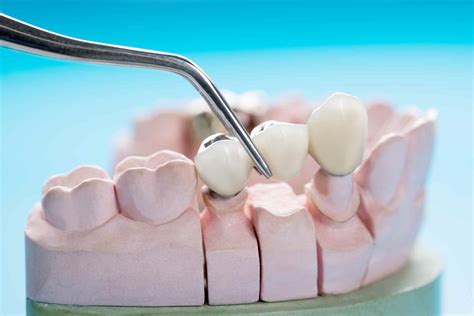 Fixed dental bridge: Understand all the details here