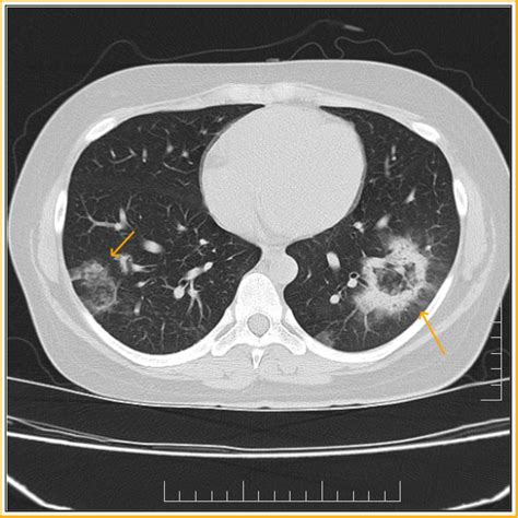 Reverse Halo Sign-CT - Sumer's Radiology Blog