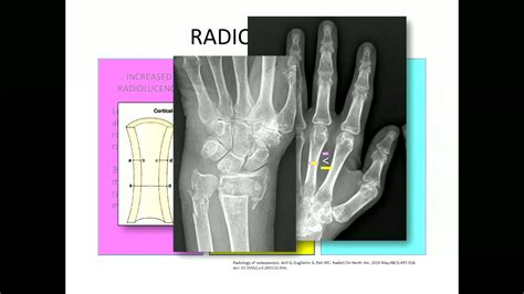 Severe Osteoporosis X Ray