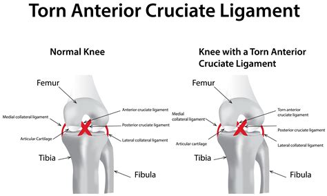 Anterior Cruciate Ligament Acl Injury Causes Symptoms Diagnosis | Hot ...