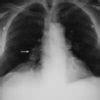 CXR eponyms in pulmonary embolism • LITFL • Medical Eponym Library