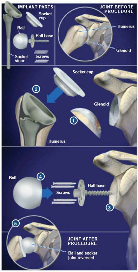 Reverse Total Shoulder Replacement | Central Coast Orthopedic Medical Group