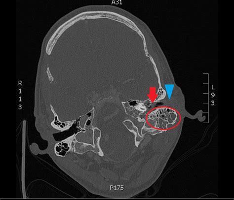 A Case of Otomastoiditis - JETem