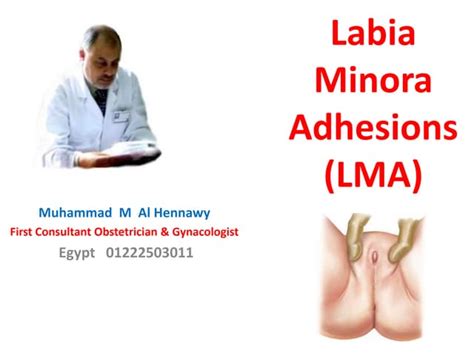 Labial adhesion | PPT