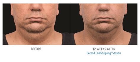 Coolsculpting Double Chin Before & After #2 - Zcosmetic Health