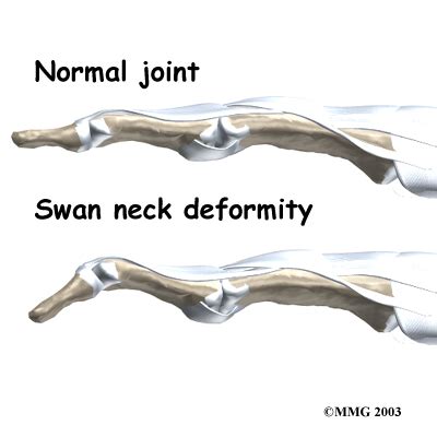 Rheumatoid Arthritis (Swan Neck Deformity of Finger) Symptoms ...