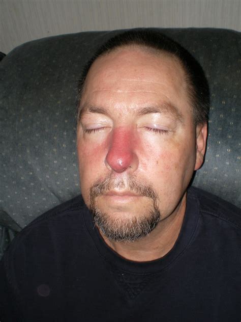 Next Day, My Husband and his red nose, he has MRSA if he i… | Flickr