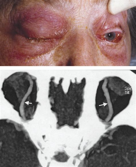 Cavernous Sinus Thrombosis