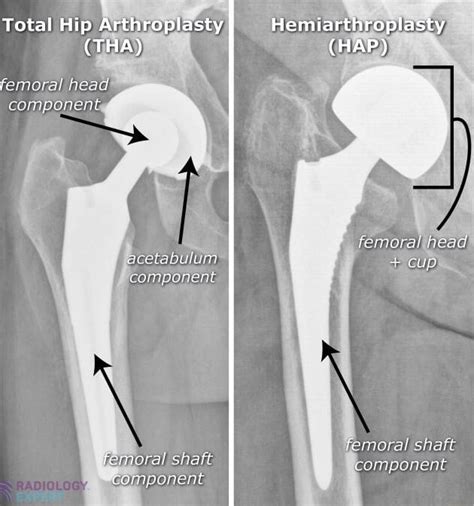 Total Hip femoral head component CHAP) cetabulum component femoral ...