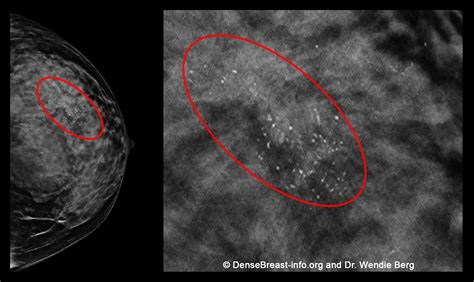 If mammograms miss some cancers in dense breasts, should I still have a mammogram? | DenseBreast ...