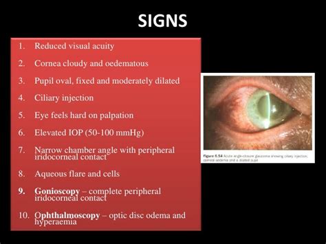 Angle Closure Glaucoma