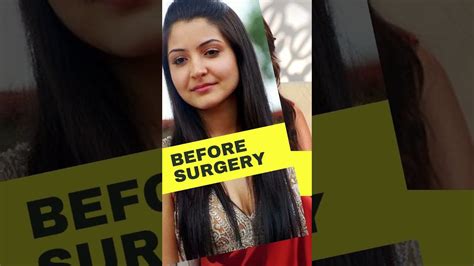 Anushka Sharma Before And After Plastic Surgery