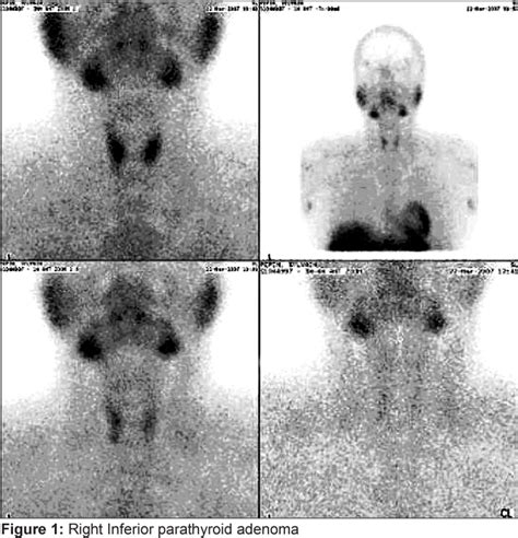 Figure 2 from Sestamibi (99mTc) scan as a single localization modality in primary ...