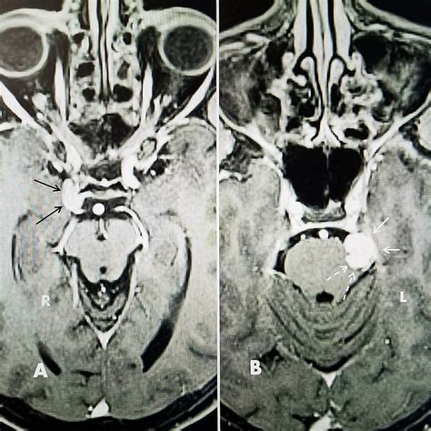 Cureus | Delayed Development of Trigeminal Neuralgia after Radiosurgical Treatment of a ...