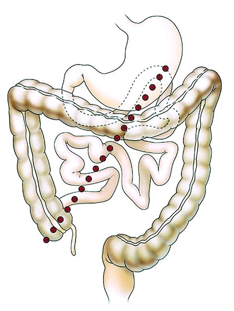 Intestinal Malrotation in Adolescents and Adults: Spectrum of Clinical and Imaging Features | AJR