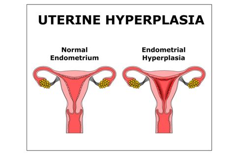 Normal Endometrium Thickness In Pregnancy - Being The Parent