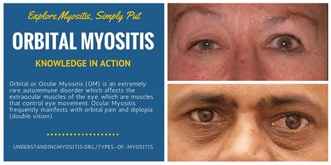 Orbital Myositis (OM) - Myositis Support and Understanding