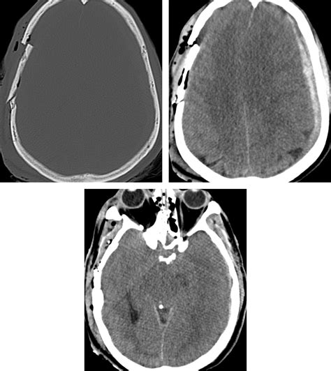 Forehead skull fracture - verypos