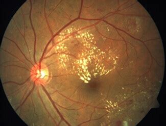 Diagnosis & Treatment of Diabetic Retinopathy | Neoretina