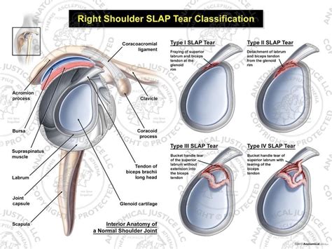 Right SLAP Tear Classification