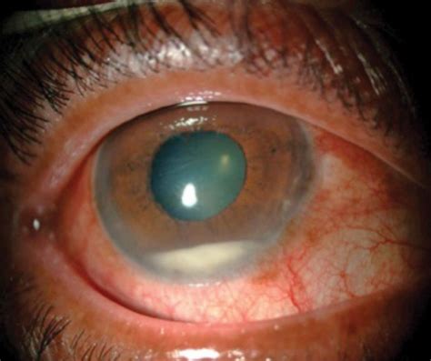 What Causes Swelling In The Eye After Cataract Surgery - Frameimage.org