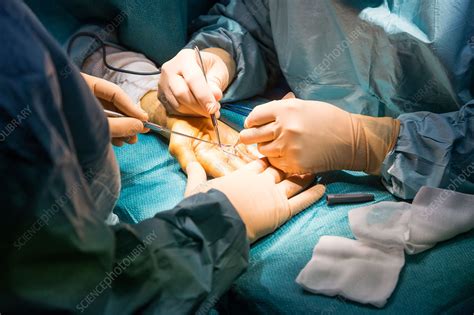 Hand surgery - Stock Image - C034/9748 - Science Photo Library