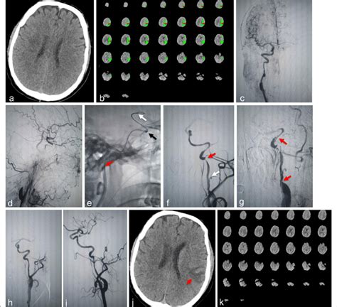 The second procedure. a-b On Sep 9, 2020, emergent head NCCT showed no... | Download Scientific ...