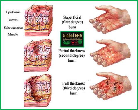 Burns First Aid Guide