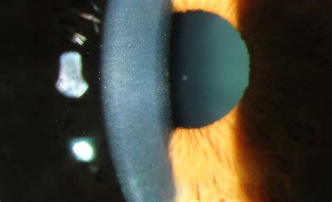 Fuchs corneal endothelial dystrophy