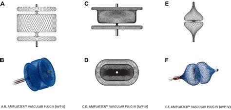 Use Of The Amplatzer Vascular Plug As An Anchoring Scaffold, 49% OFF