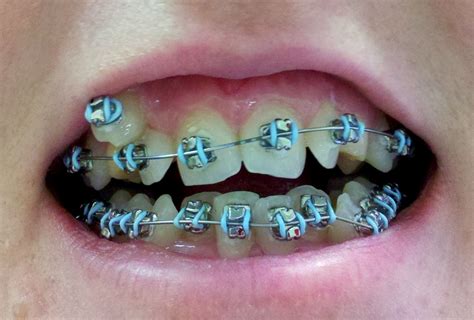 dental braces teeth | Braces colors, Teeth braces, Cute braces colors