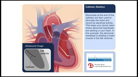 Catheter Ablation Animation Video - Afib Treatment Today