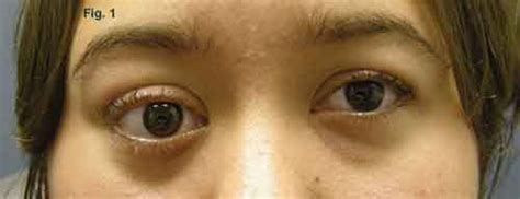 Homocystinuria: Symptoms of Homocystinuria