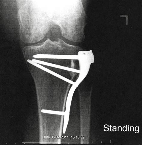 My Tibial Plateau Fracture (TPF) Rehab & Recovery: Three Year Anniversary