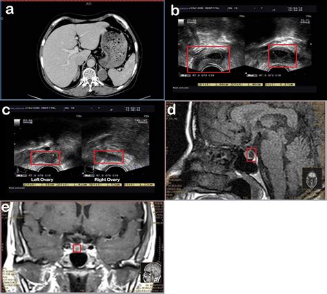 Refractory hypokalemia with sexual dysplasia and infertility caused by ...