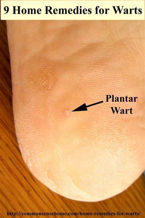 Home Remedies for Warts