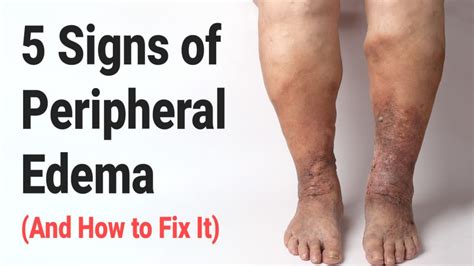 Peripheral Edema Symptoms Causes Treatment | Hot Sex Picture