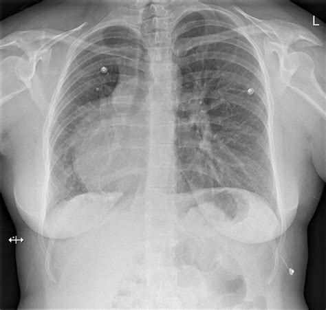 Dextrocardia x-ray - wikidoc