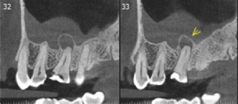 Lamina dura in CBCT