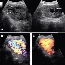 Family Medicine Topics: Hydatidiform Mole: Use of Ultrasound in Diagnosis of Hydatidiform Moles