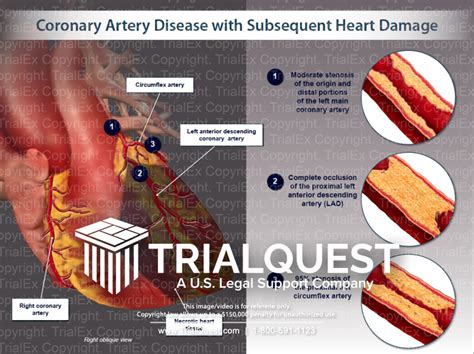 Coronary Heart Disease