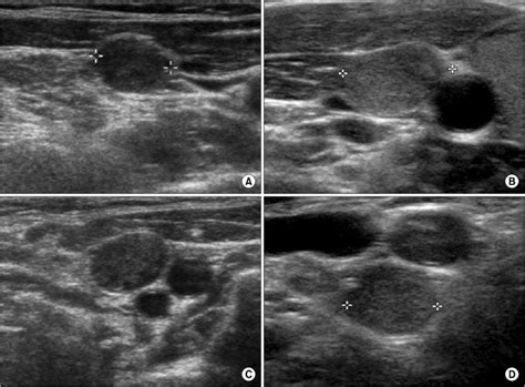 Ultrasound images of central lymph node metastasis. (A) LNM with a loss... | Download Scientific ...