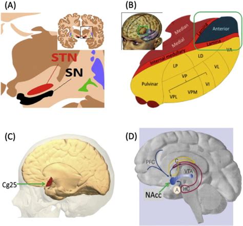 DBT targets: (A) subthalamic nucleus (coronal view, yellow, labeled ...