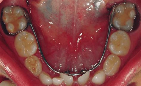 The soldered lingual arch made with bands on the permanent mandibular ...