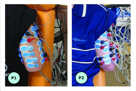 | View of the residual limbs with the connected six optimal (P1, left),... | Download Scientific ...